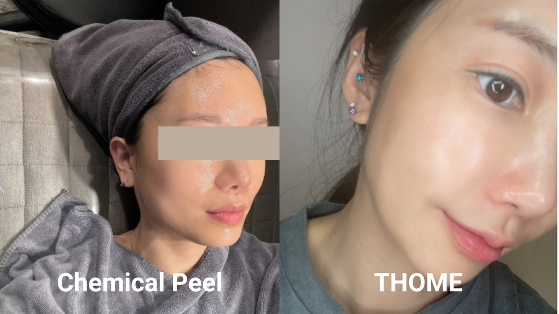 [Click Here] THOME VS Chemical Peel - My Authentic Review